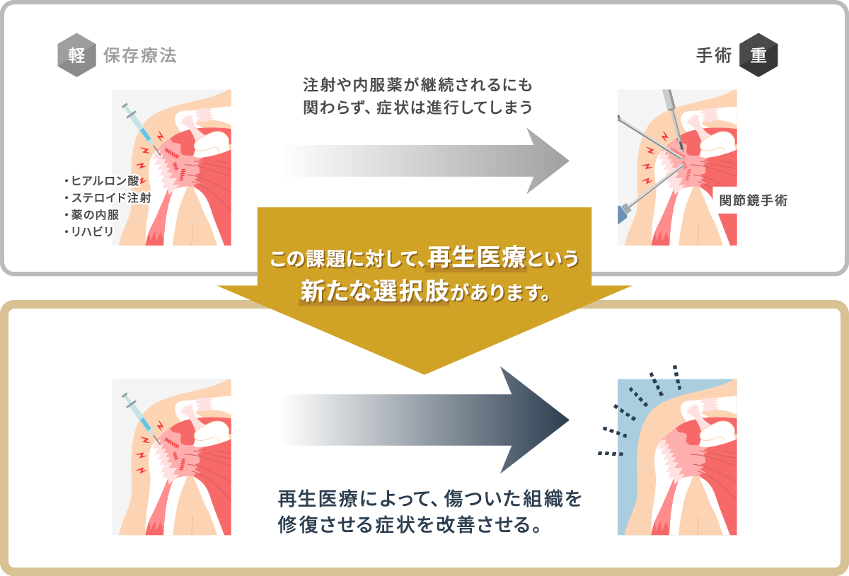 肩の再生医療