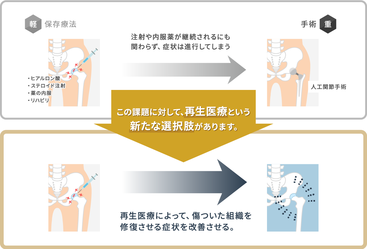 股関節の再生医療