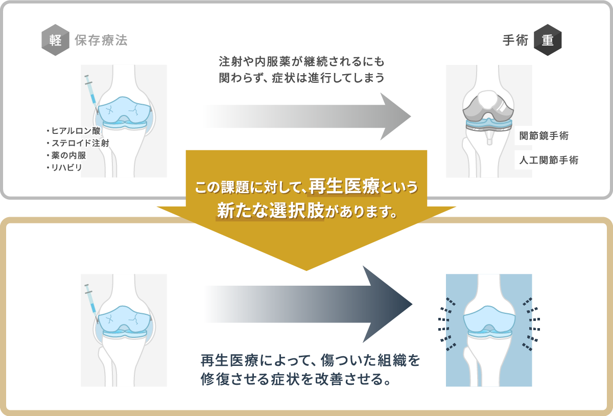 ひざの再生医療