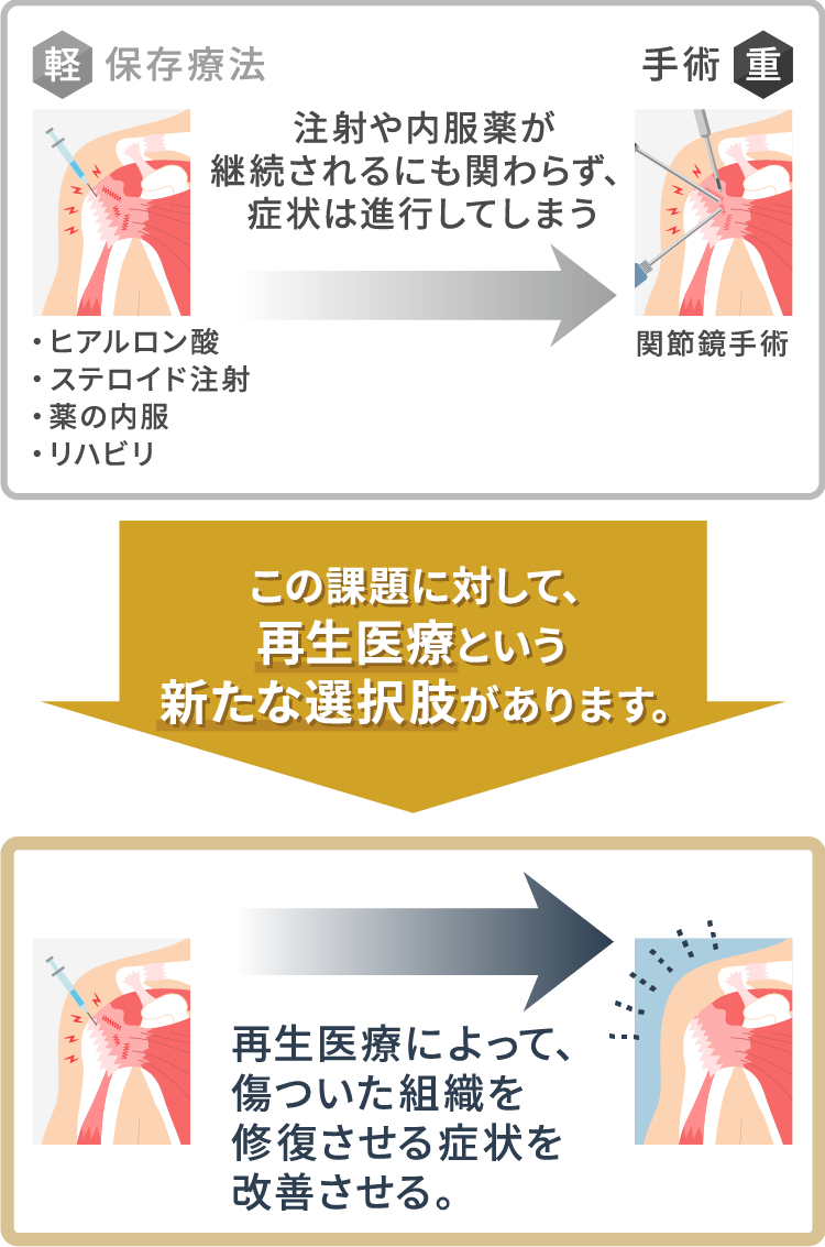 肩の再生医療