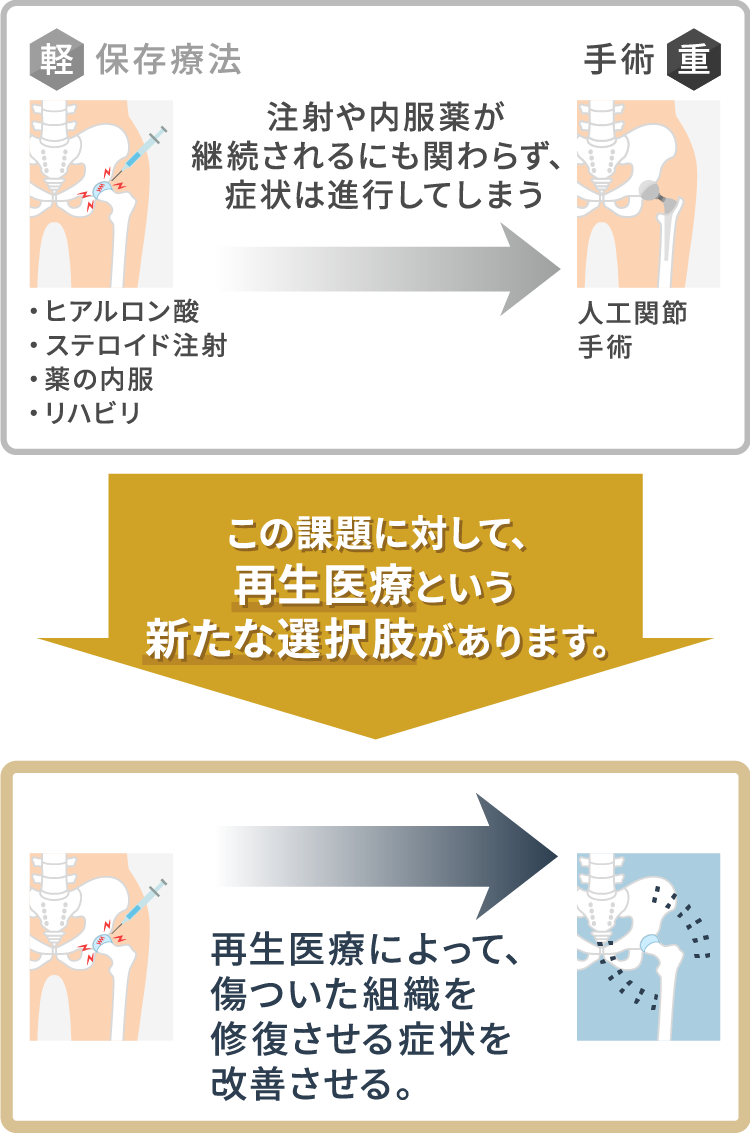 股関節の再生医療