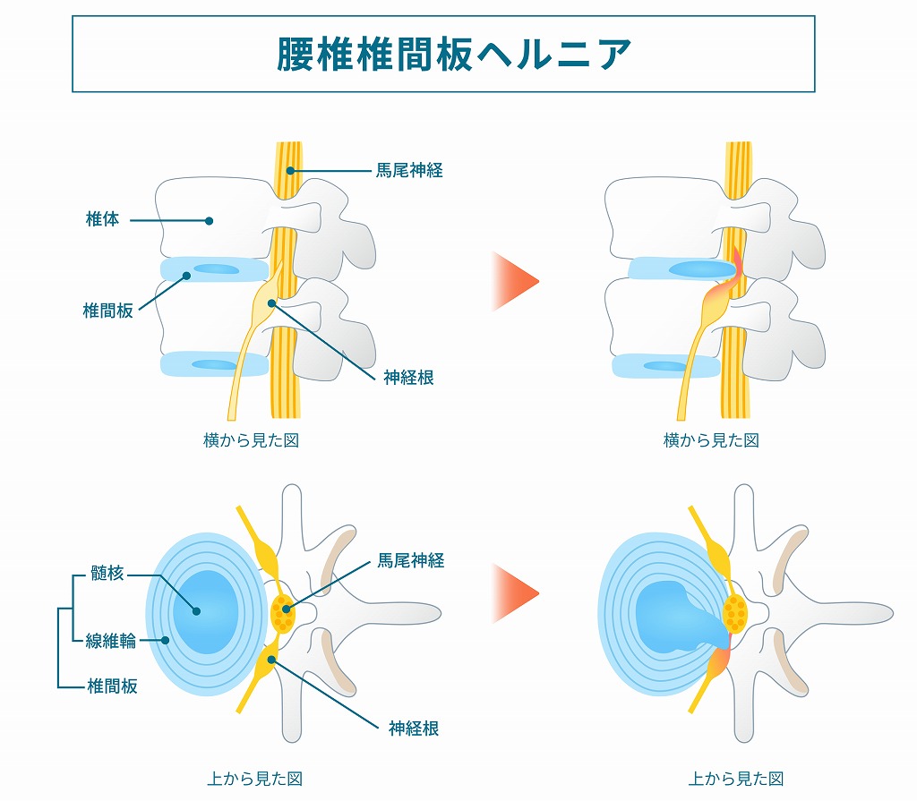 椎間板ヘルニア