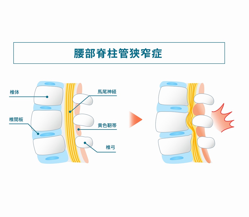 脊柱管狭窄症